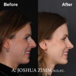 Rhinoplasty - before and after