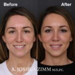 Rhinoplasty - before and after