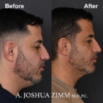 Chin implant - before and after