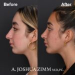 Chin implant - before and after