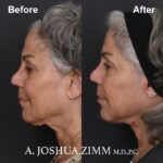 Facelift - before and after