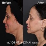 Facelift - before and after