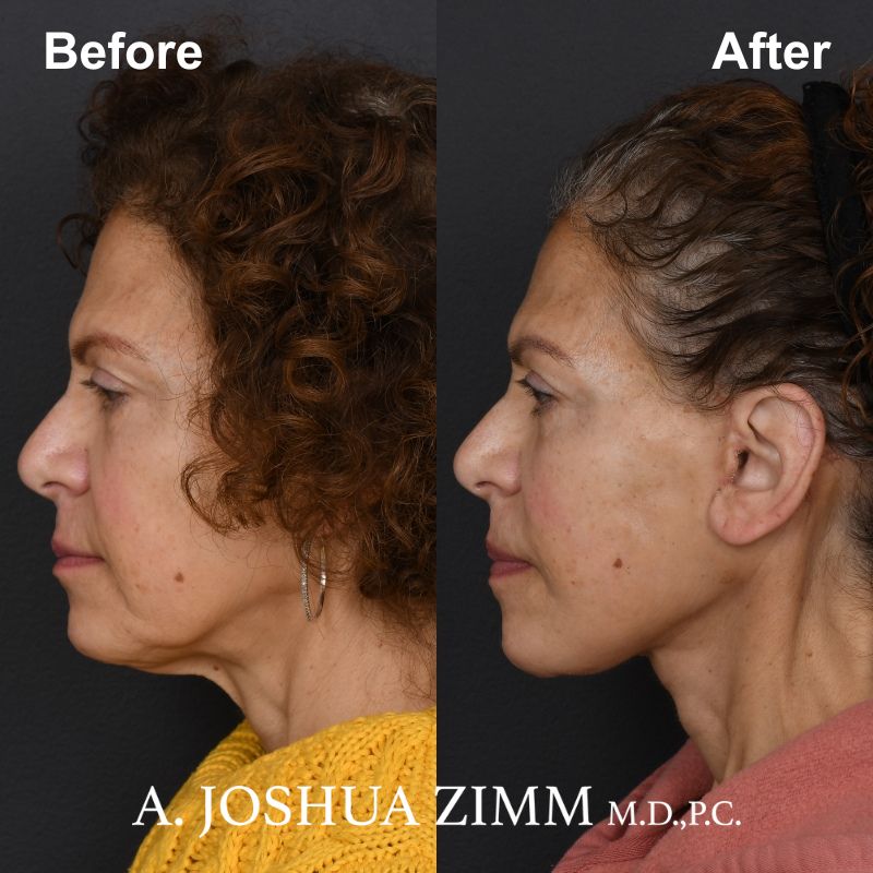 Facelift - before and after