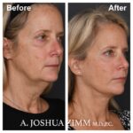 Facelift - before and after