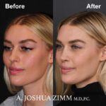 Rhinoplasty - before and after