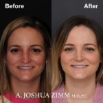 Rhinoplasty - before and after