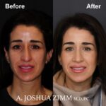 Rhinoplasty - before and after