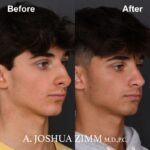 Rhinoplasty - before and after