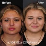 Rhinoplasty - before and after