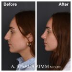 Rhinoplasty - before and after