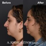 Rhinoplasty - before and after