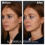 Rhinoplasty - before and after