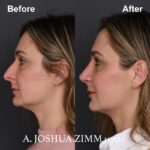 Rhinoplasty - before and after