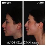 Rhinoplasty - before and after