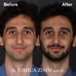 Rhinoplasty - before and after