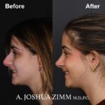 Rhinoplasty - before and after