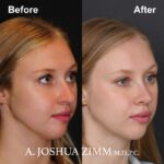 Rhinoplasty - before and after