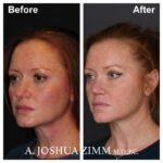 Rhinoplasty - before and after