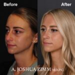 Rhinoplasty - before and after