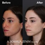 Rhinoplasty - before and after