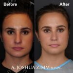 Rhinoplasty - before and after