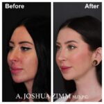 Rhinoplasty - before and after