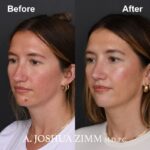 Rhinoplasty - before and after