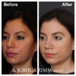 Rhinoplasty - before and after