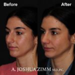 Rhinoplasty - before and after