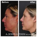 Rhinoplasty - before and after