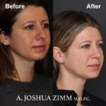 Rhinoplasty - before and after