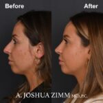 Rhinoplasty - before and after