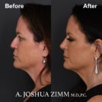 Rhinoplasty - before and after