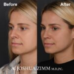 Rhinoplasty - before and after