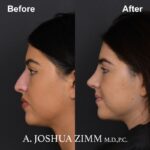 Rhinoplasty - before and after