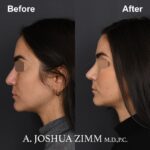 Rhinoplasty - before and after