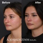 Rhinoplasty - before and after