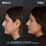 Rhinoplasty - before and after