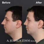 Rhinoplasty - before and after