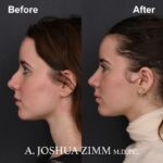 Rhinoplasty - before and after