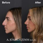 Rhinoplasty - before and after