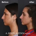 Rhinoplasty - before and after