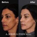 Rhinoplasty - before and after