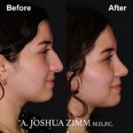 Rhinoplasty - before and after