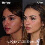 Rhinoplasty - before and after