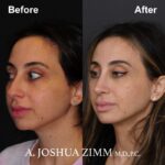 Rhinoplasty - before and after