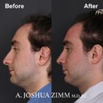 Rhinoplasty - before and after