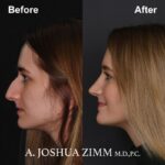 Rhinoplasty - before and after