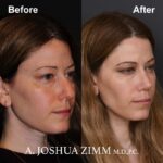 Rhinoplasty - before and after