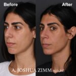 Rhinoplasty - before and after